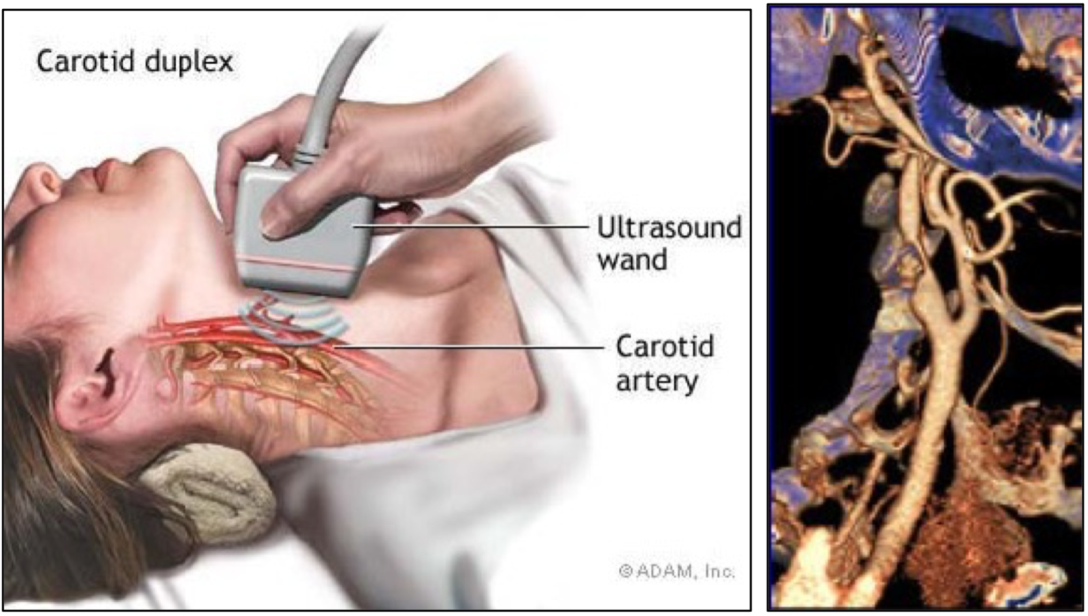graphic showing ultrasound wand over carotid artery