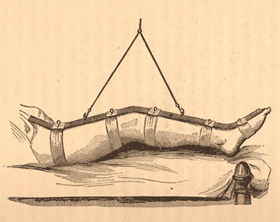 A hand-drawn image of Nathan R. Smith’s anterior splint, which stabilized a soldier’s injured leg, allowing him to be moved with less pain and risk of further injury.