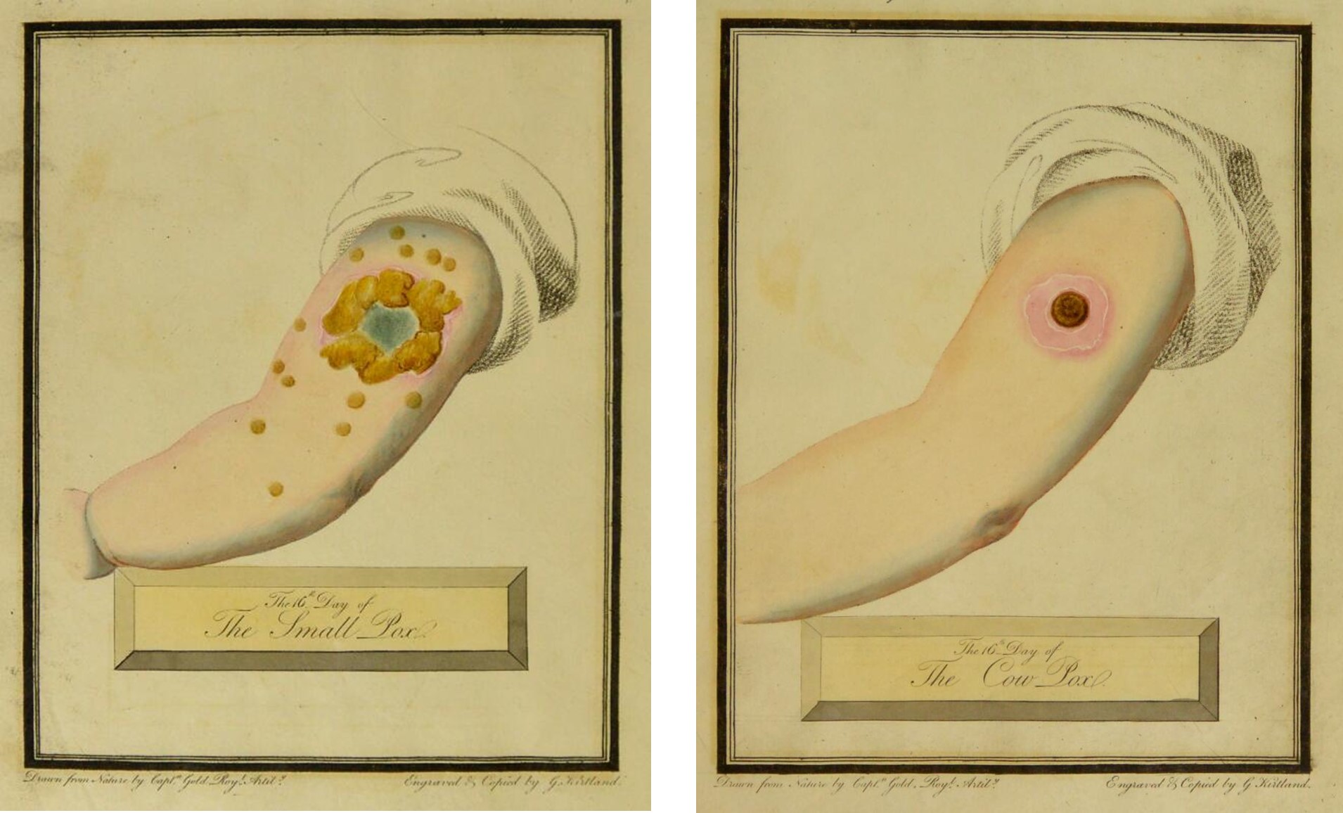 The left image shows an arm with the Small Pox vaccine, it shows wound surrounded by brown pox marks.  The right arm shows the cow pox vaccination, it has a small red mark surrounded by pink skin.