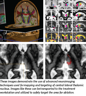 Trigeminal Neuralgia Imaging